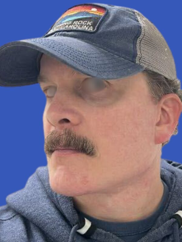 Deep Plane Necklift Before & After Image