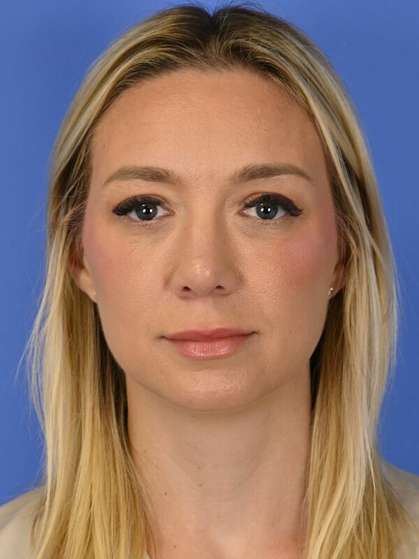 Deep Plane Necklift Before & After Image