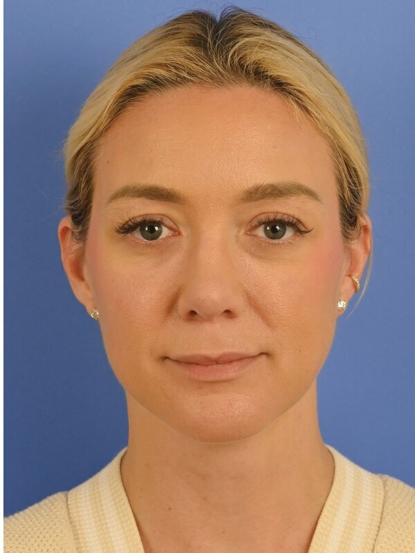 Deep Plane Necklift Before & After Image
