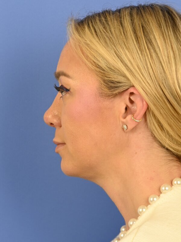 Deep Plane Necklift Before & After Image