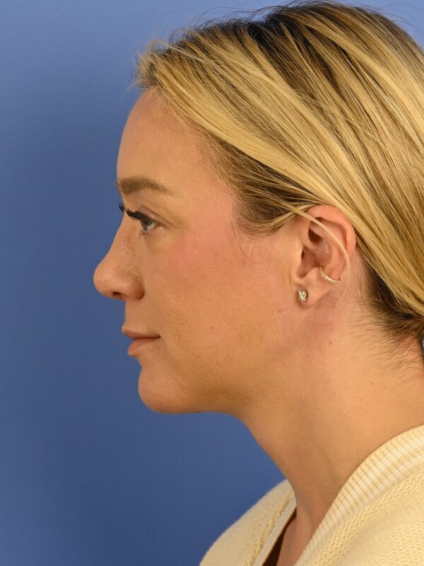 Deep Plane Necklift Before & After Image