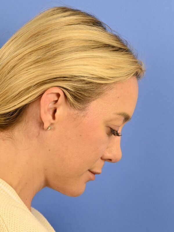 Deep Plane Necklift Before & After Image