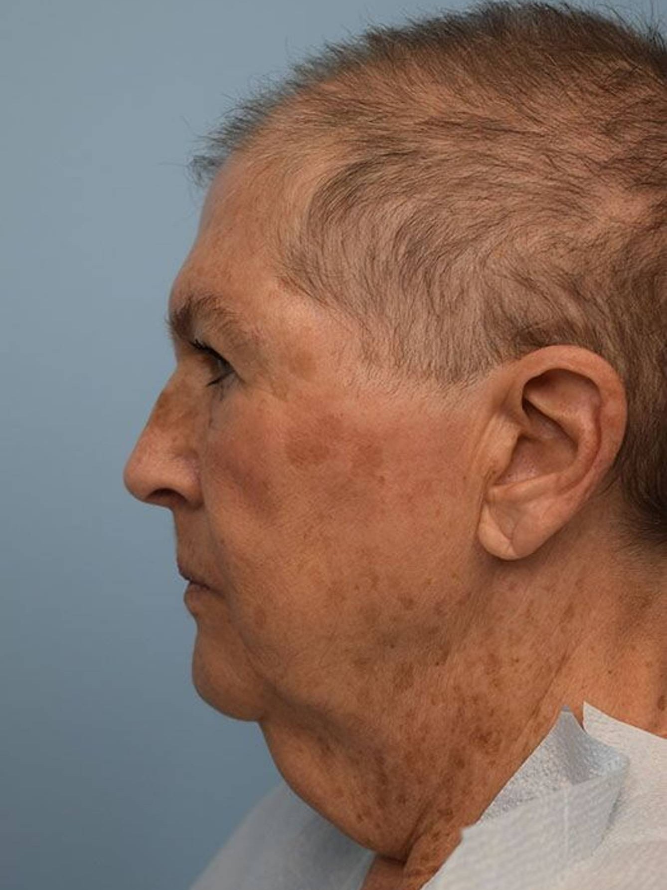 Direct Neck Lift Before & After Image