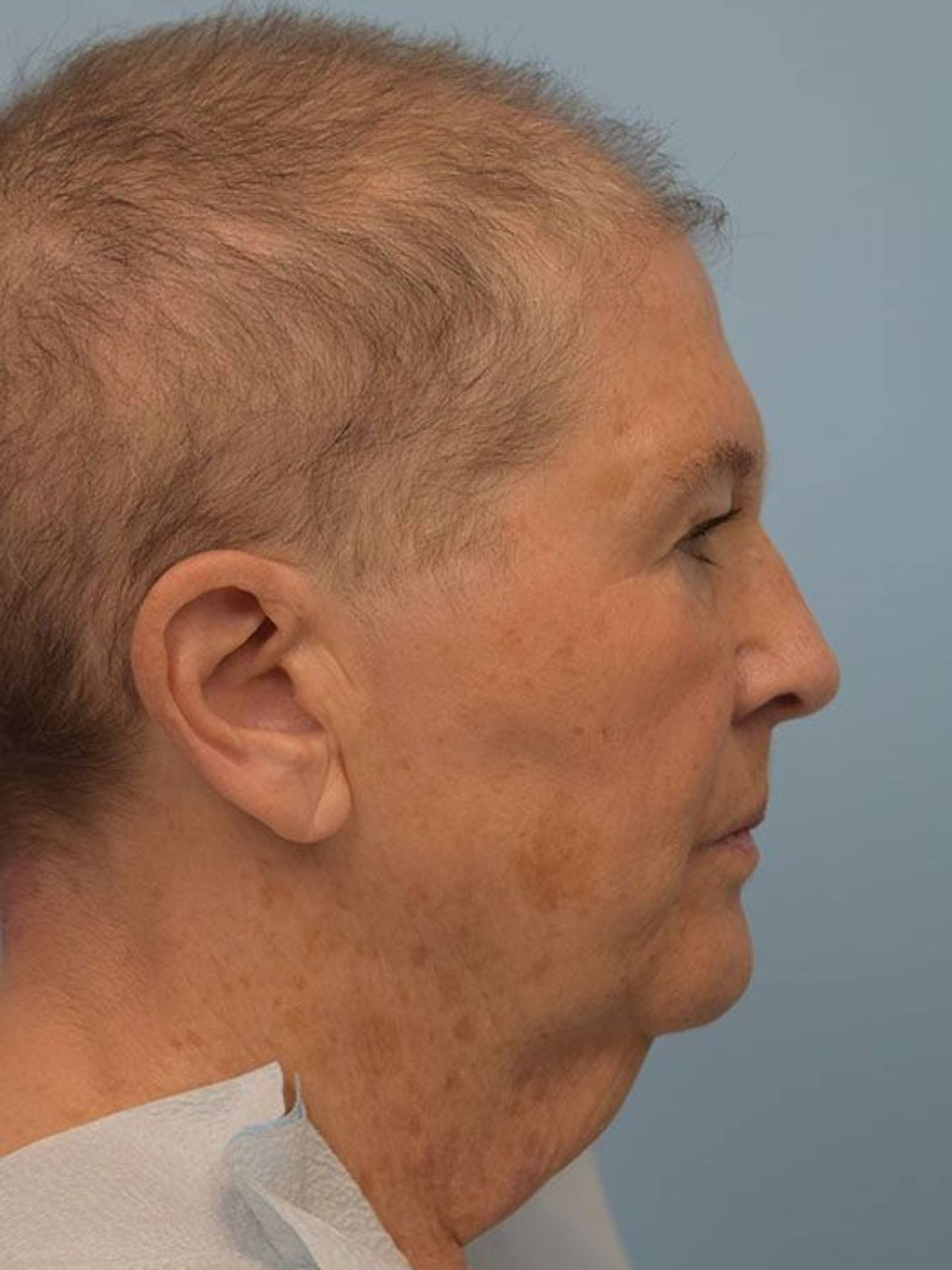 Direct Neck Lift Before & After Image