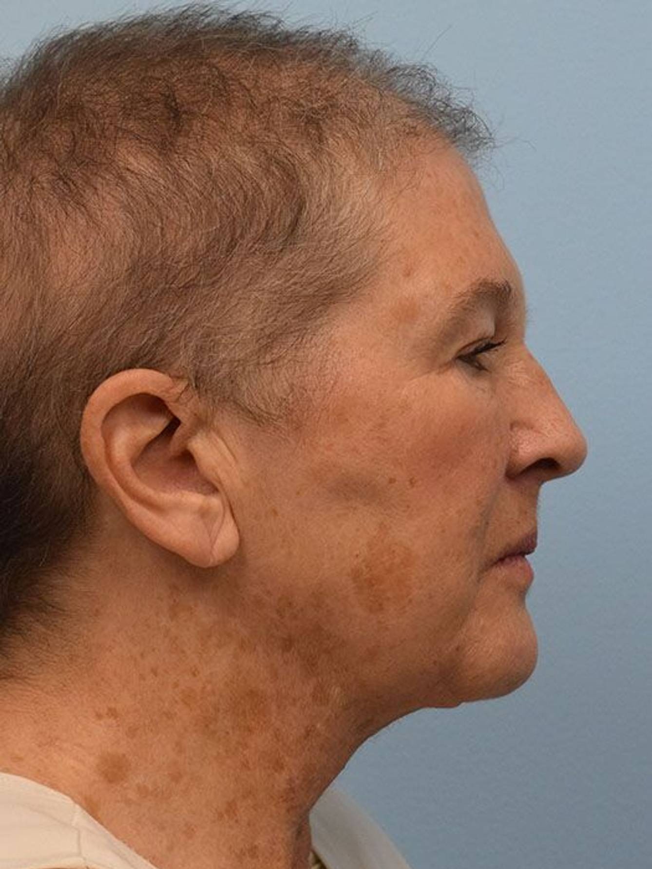 Direct Neck Lift Before & After Image