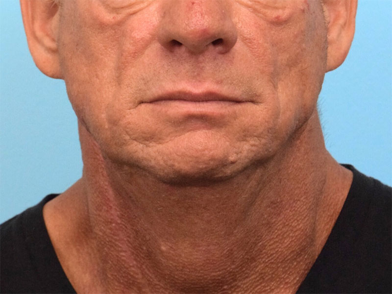 Direct Neck Lift Before & After Image