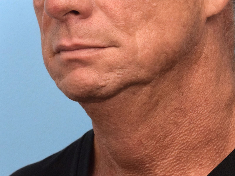 Direct Neck Lift Before & After Image