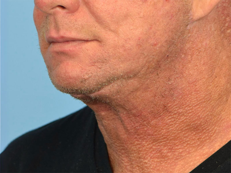 Direct Neck Lift Before & After Image