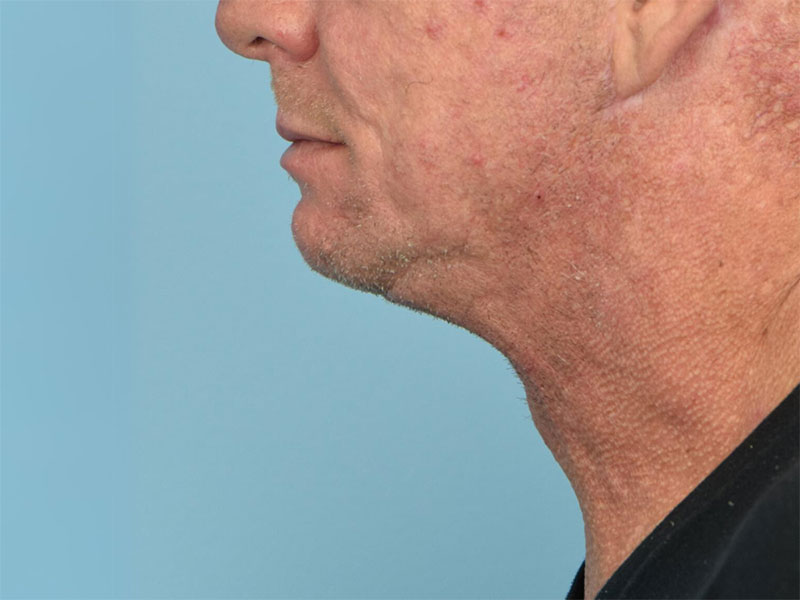 Direct Neck Lift Before & After Image