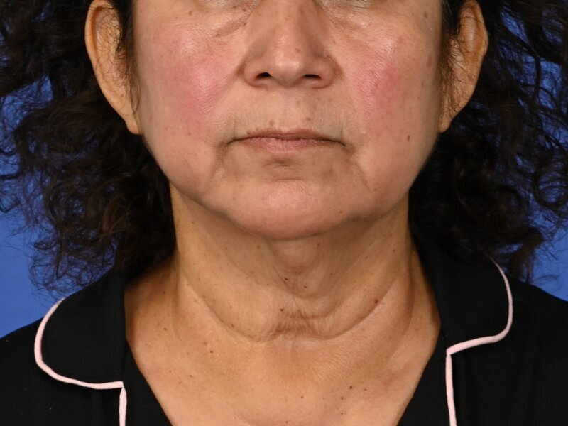 Direct Neck Lift Before & After Image