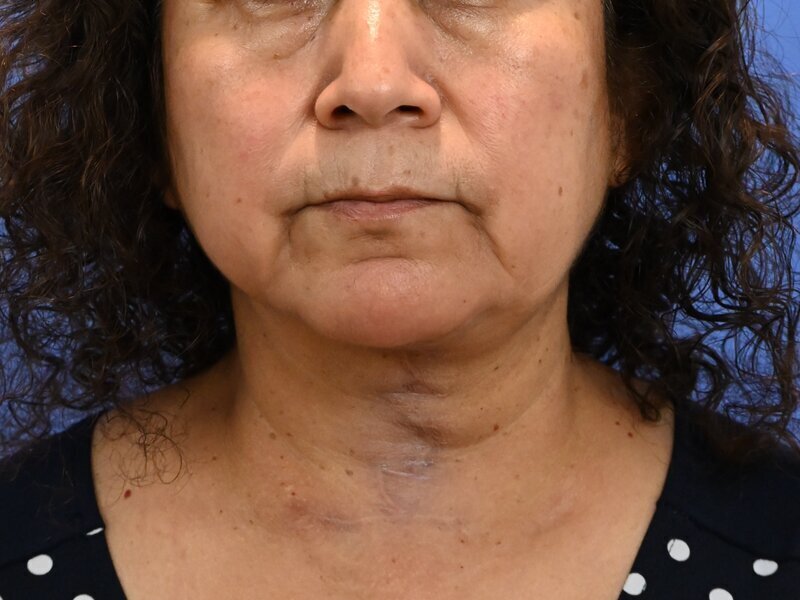 Direct Neck Lift Before & After Image