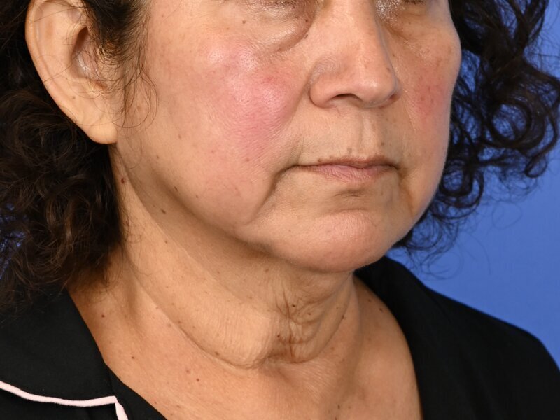 Direct Neck Lift Before & After Image
