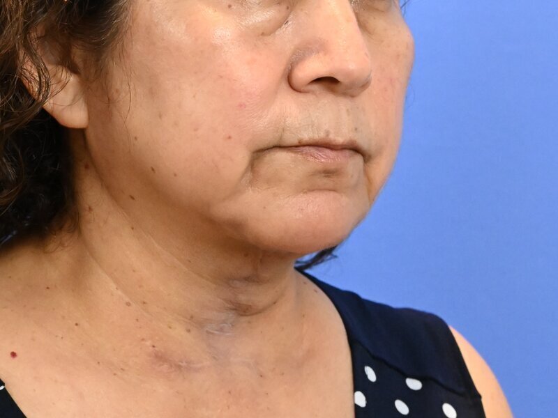 Direct Neck Lift Before & After Image