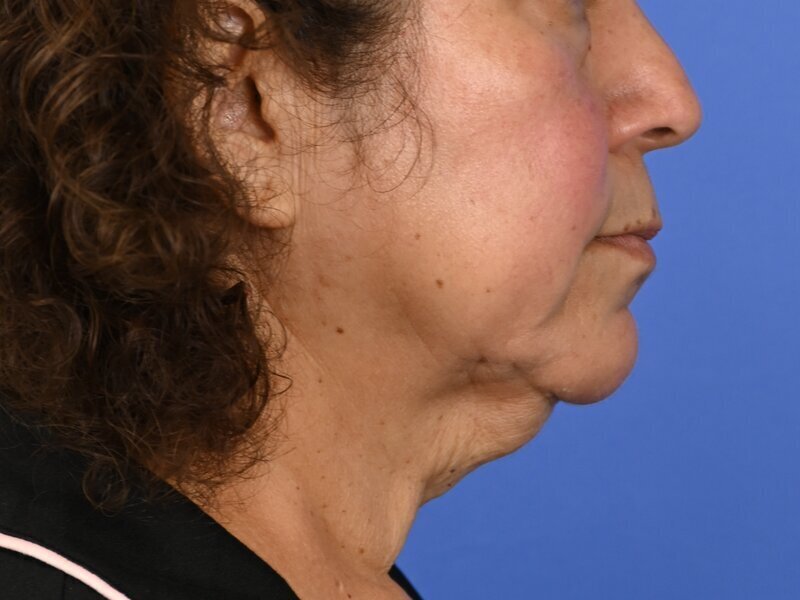 Direct Neck Lift Before & After Image