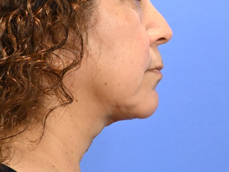 Direct Neck Lift Before & After Image