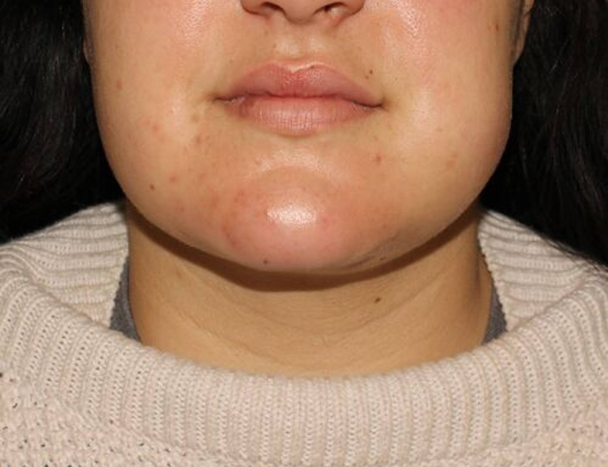 Neck Liposuction Before & After Image