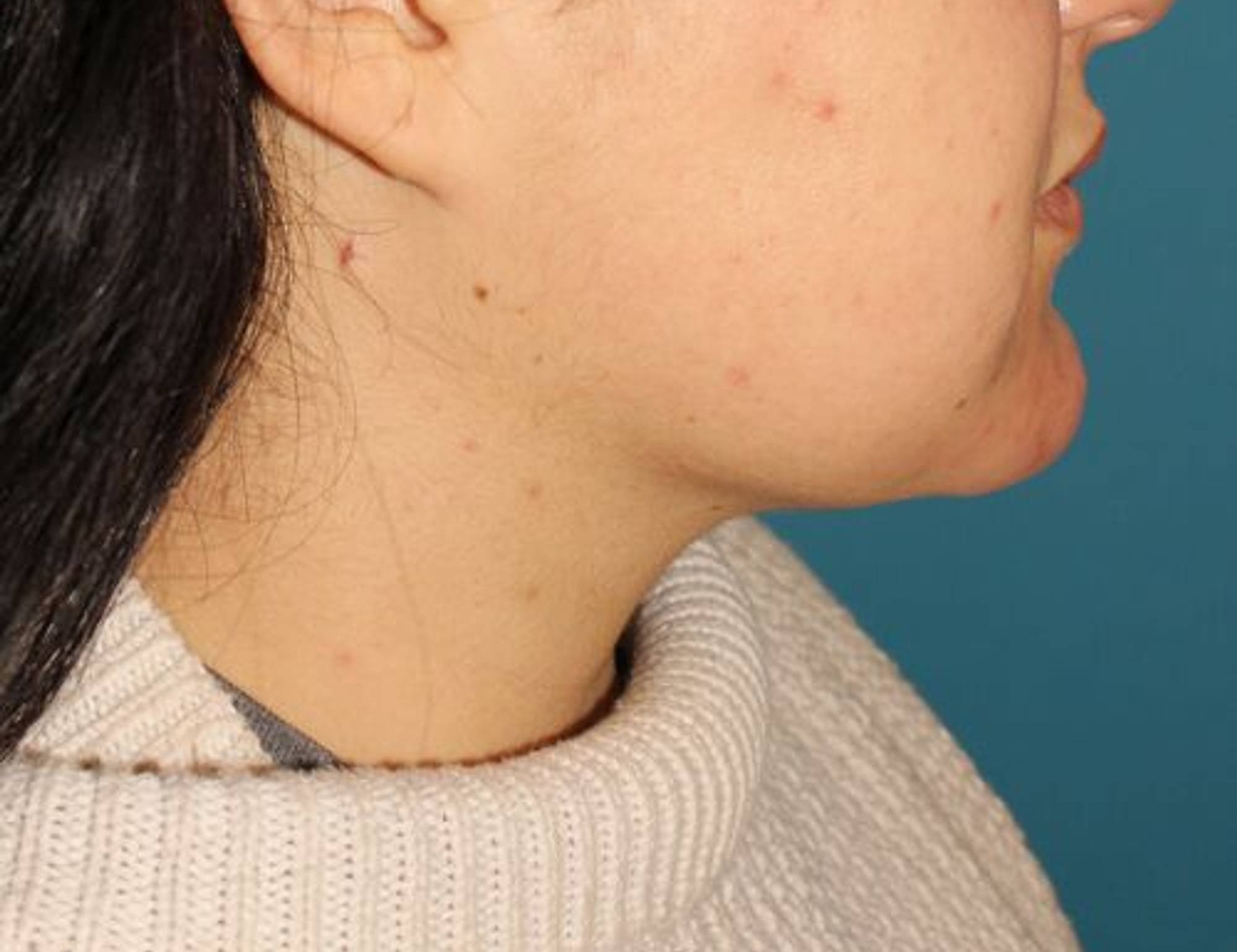 Neck Liposuction Before & After Image