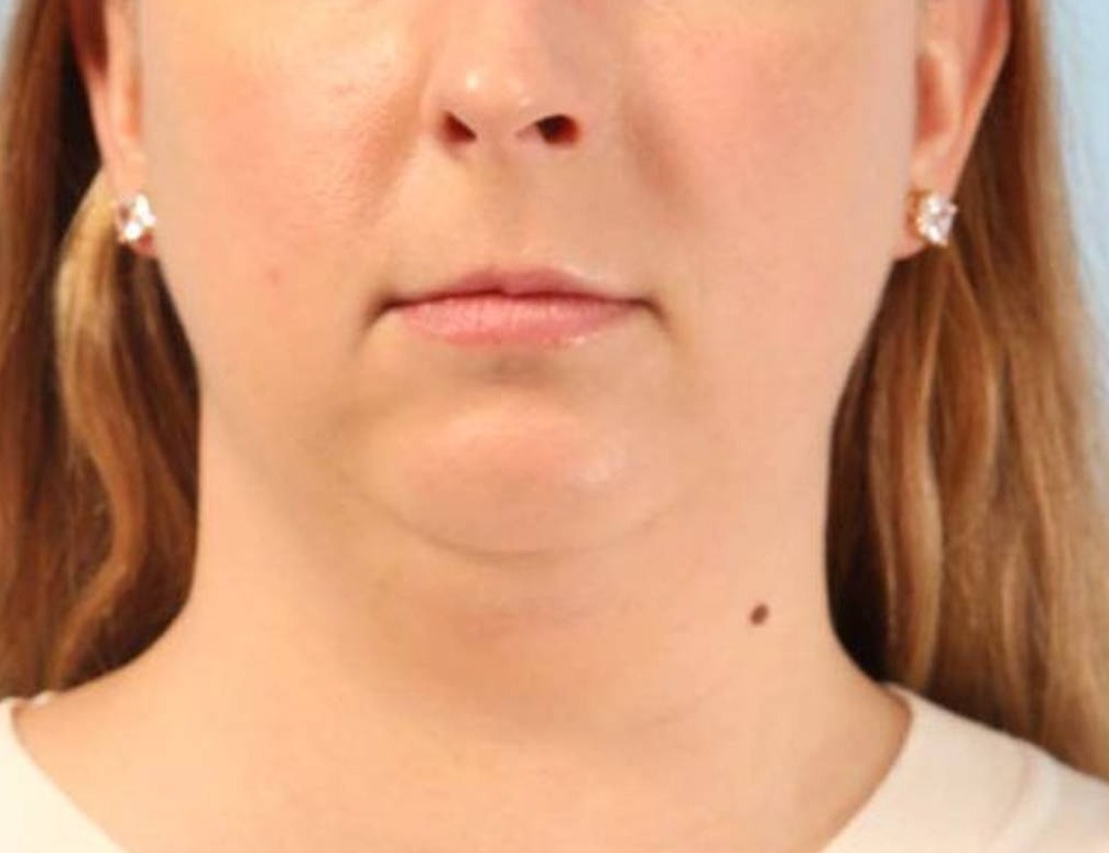 Neck Liposuction Before & After Image