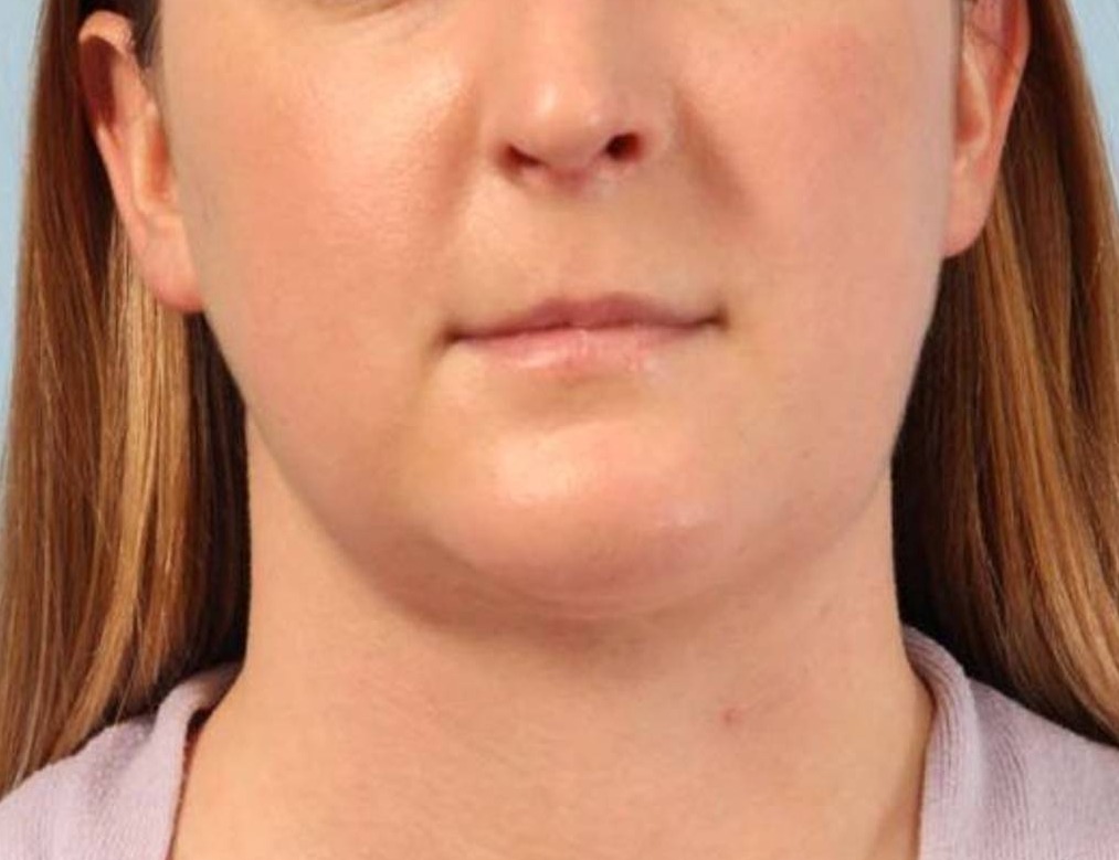 Neck Liposuction Before & After Image