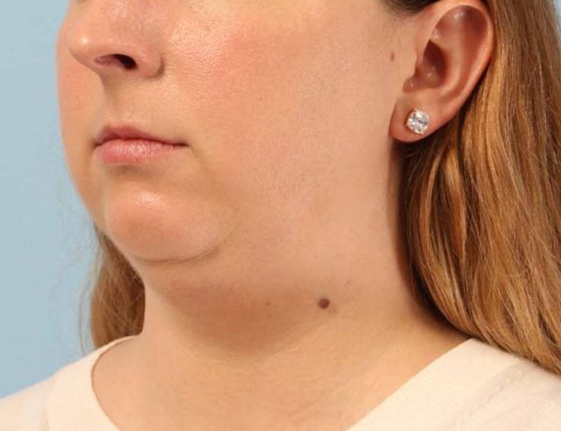 Neck Liposuction Before & After Image