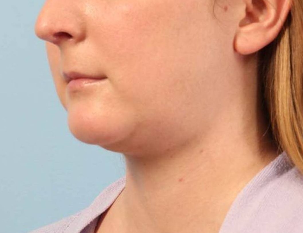 Neck Liposuction Before & After Image