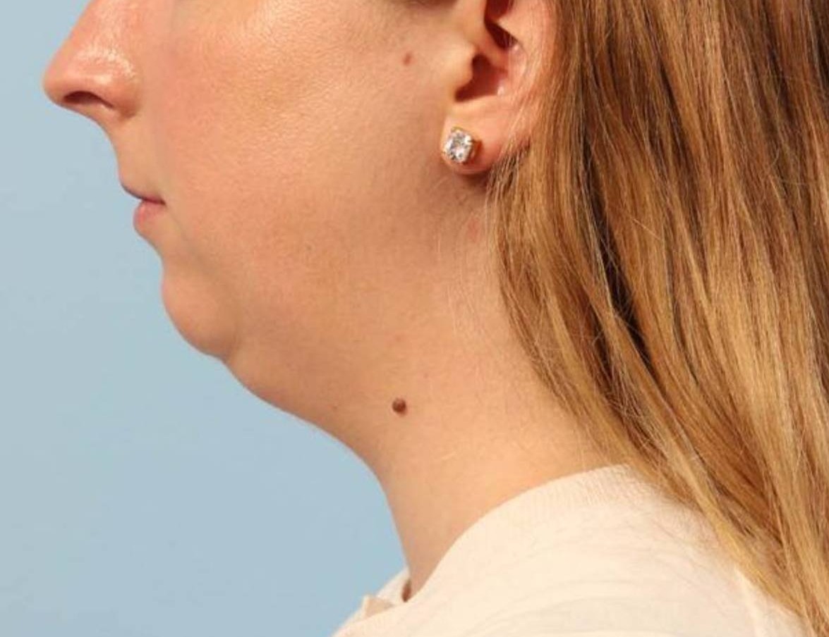 Neck Liposuction Before & After Image