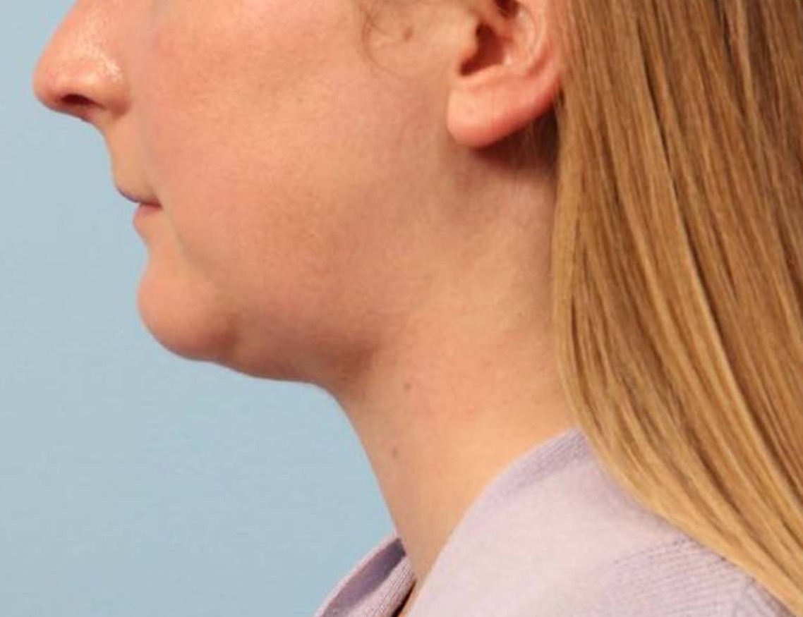 Neck Liposuction Before & After Image