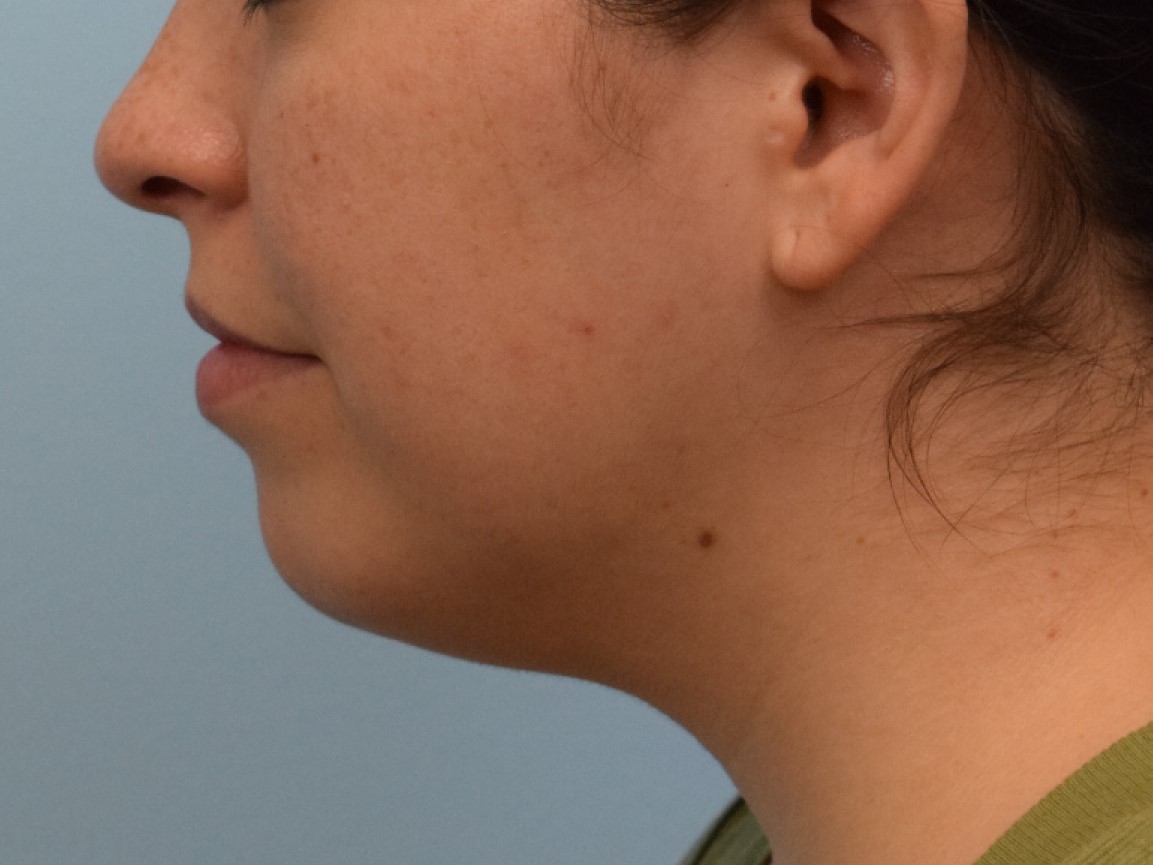 Neck Liposuction Before & After Image