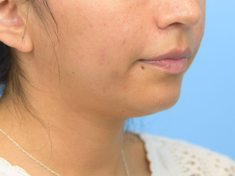 Neck Liposuction Before & After Image