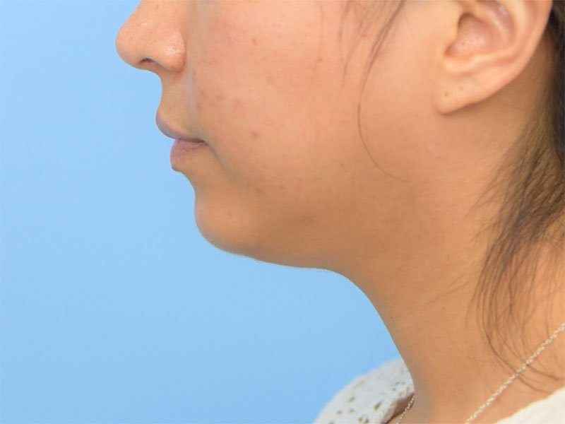 Neck Liposuction Before & After Image