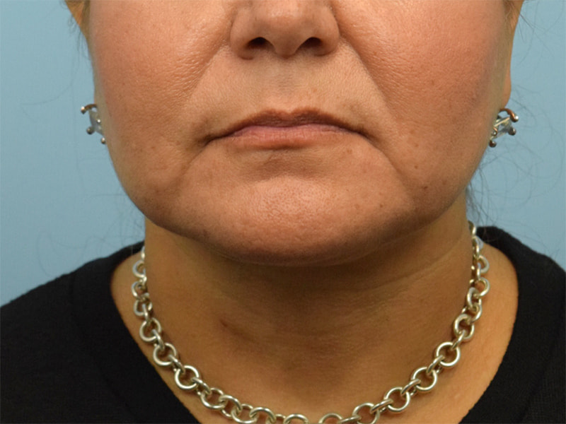 Neck Liposuction Before & After Image