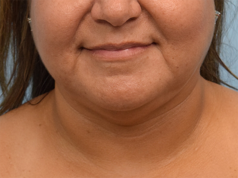 Neck Liposuction Before & After Image