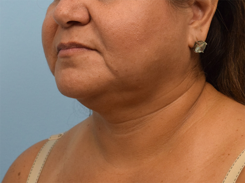 Neck Liposuction Before & After Image