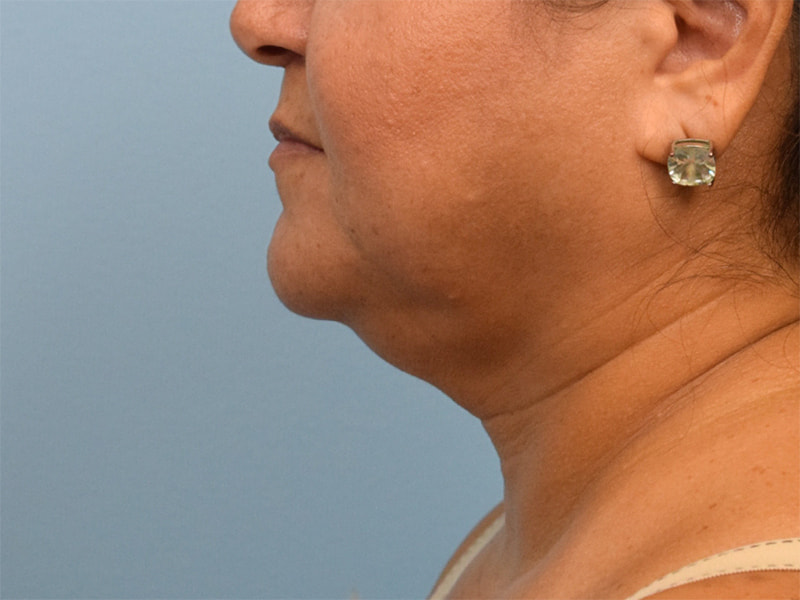 Neck Liposuction Before & After Image