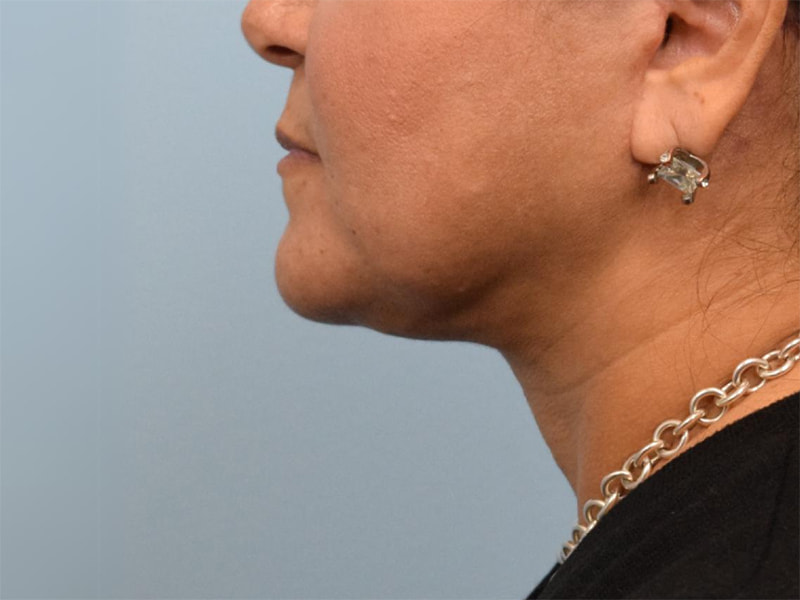 Neck Liposuction Before & After Image