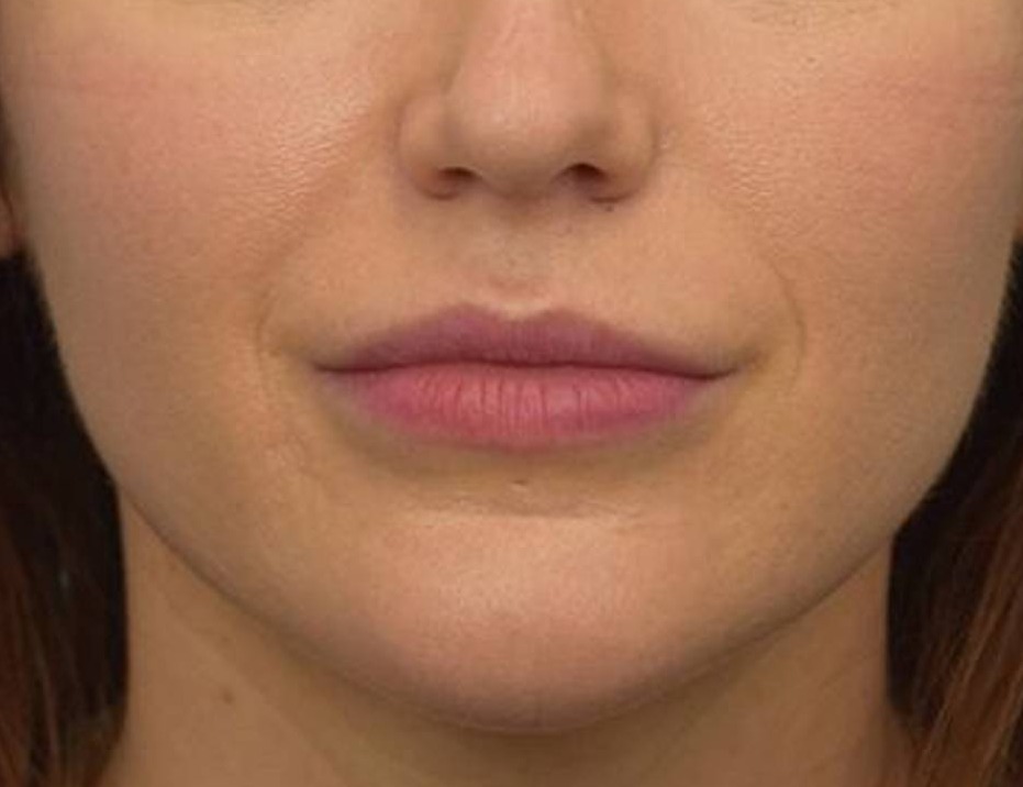 Renuvion Skin Tightening Before & After Image