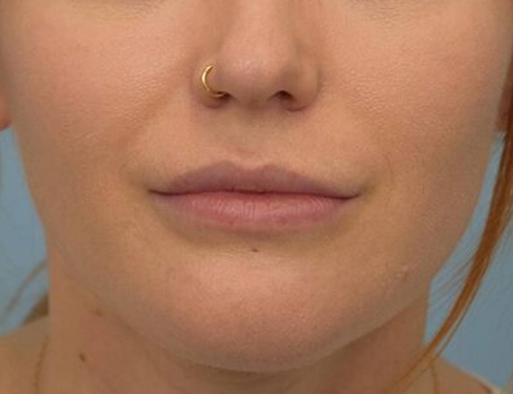 Renuvion Skin Tightening Before & After Image