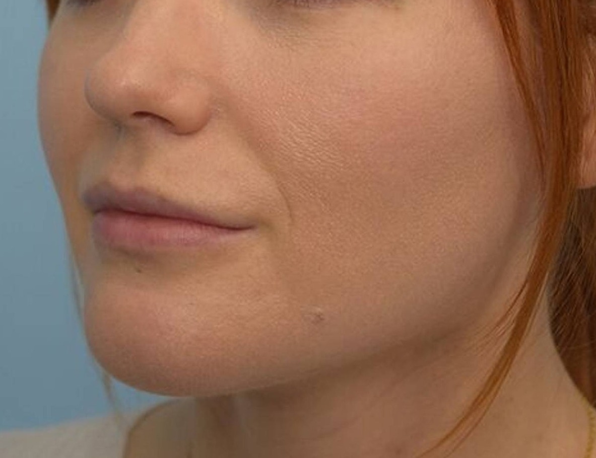 Renuvion Skin Tightening Before & After Image