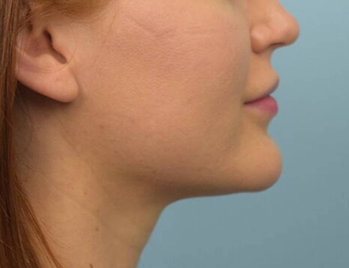 Renuvion Skin Tightening Before & After Image