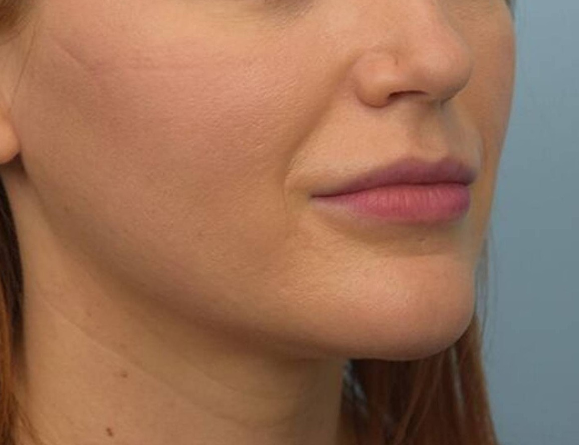 Renuvion Skin Tightening Before & After Image