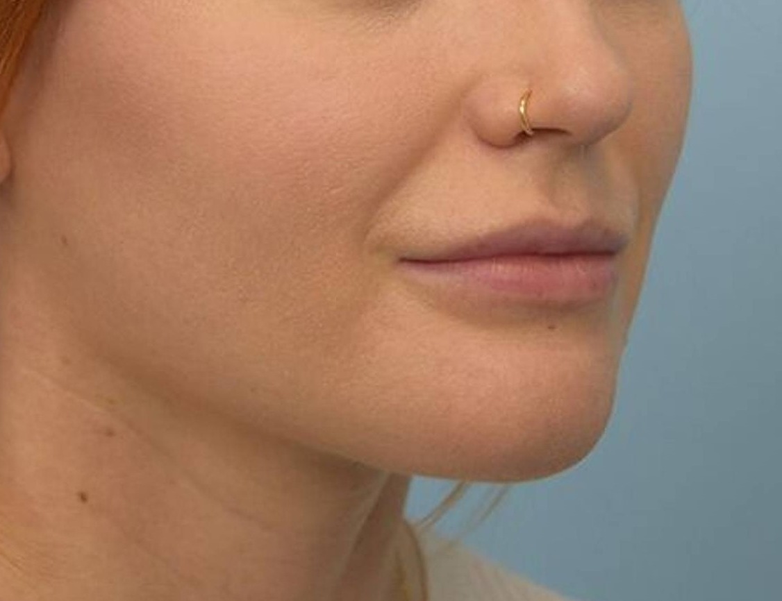 Renuvion Skin Tightening Before & After Image