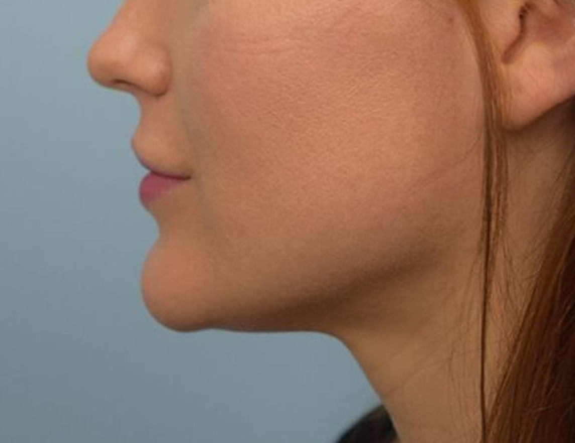 Renuvion Skin Tightening Before & After Image