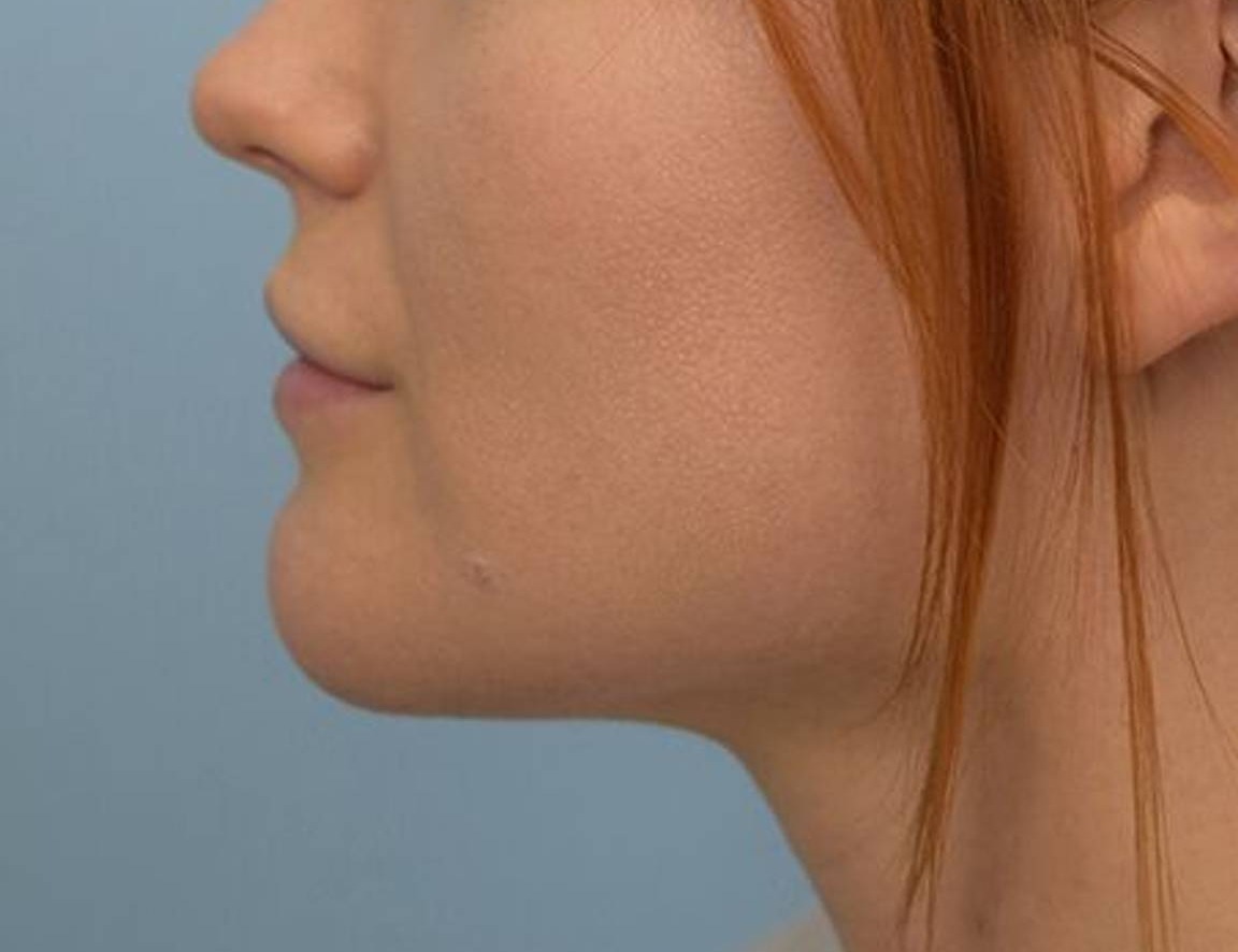 Renuvion Skin Tightening Before & After Image