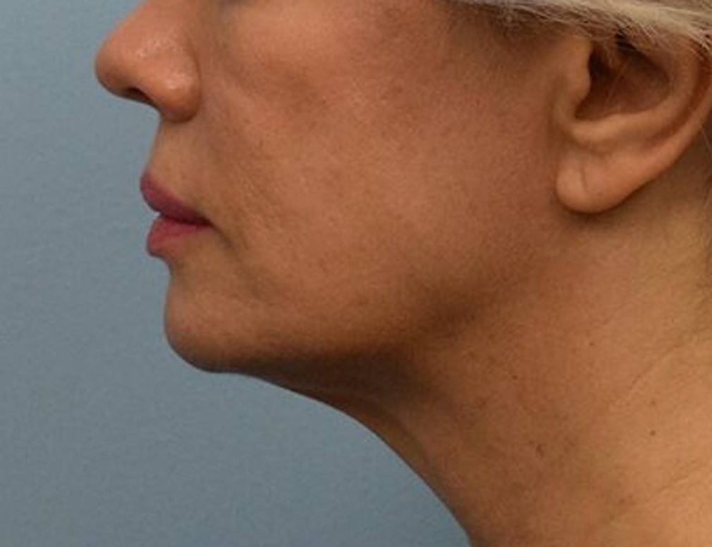 Renuvion Skin Tightening Before & After Image