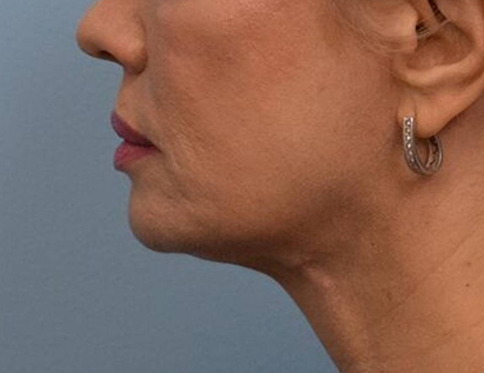 Renuvion Skin Tightening Before & After Image