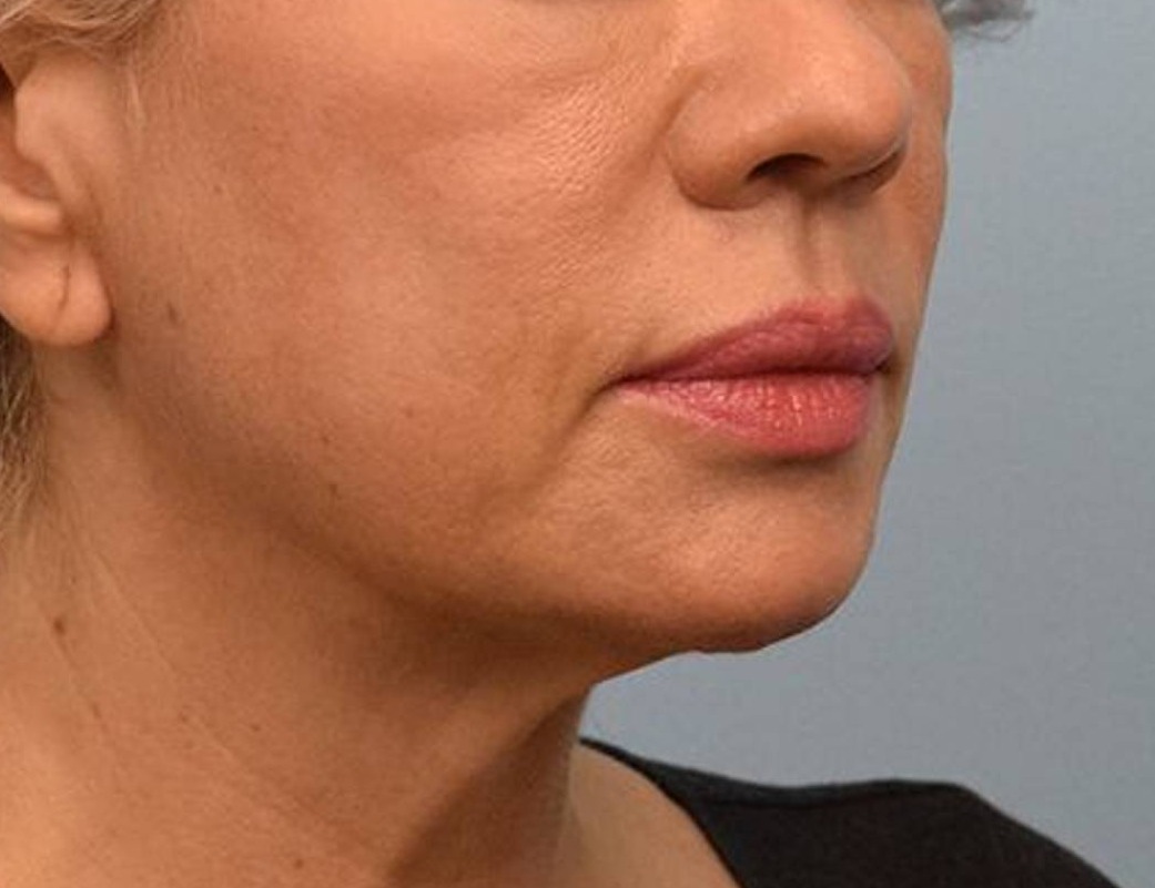 Renuvion Skin Tightening Before & After Image