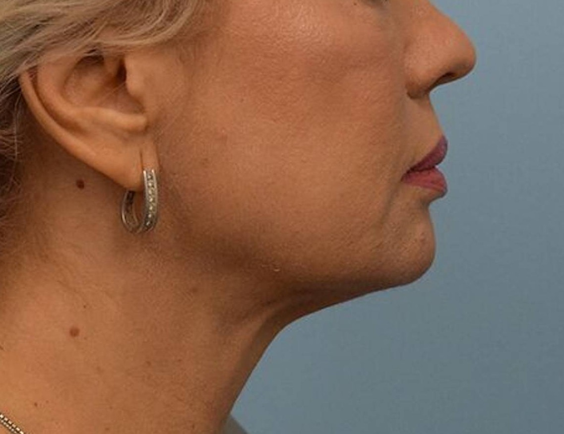 Renuvion Skin Tightening Before & After Image