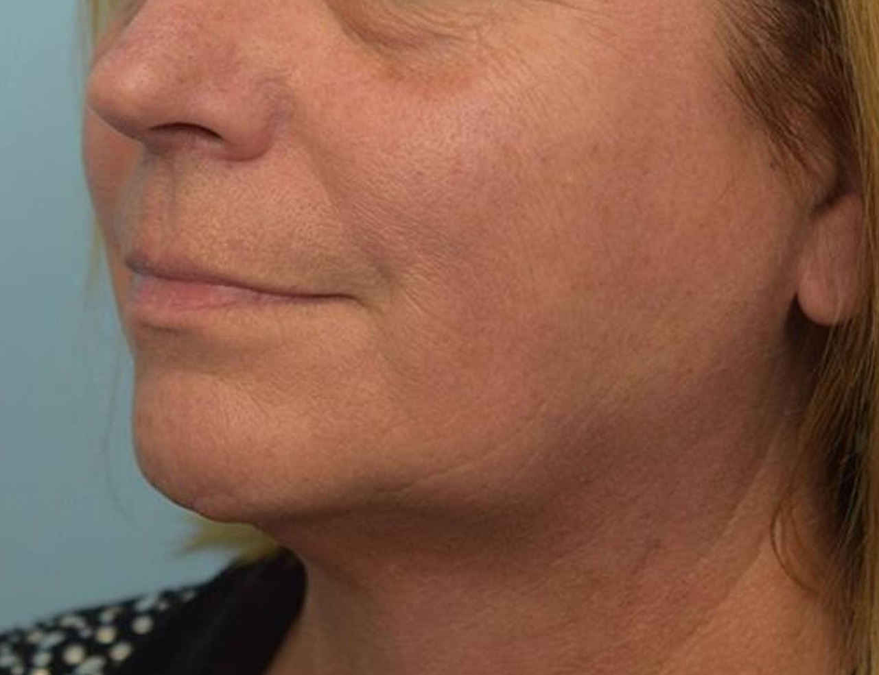 Renuvion Skin Tightening Before & After Image