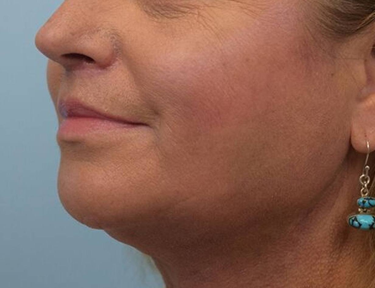 Renuvion Skin Tightening Before & After Image