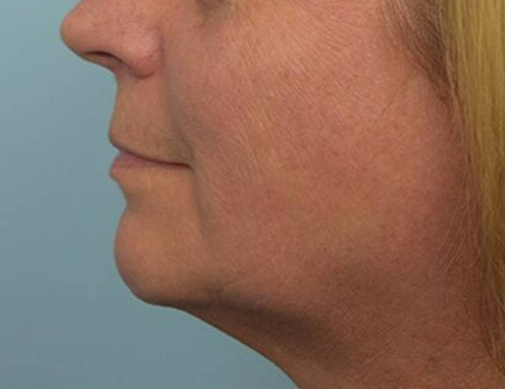 Renuvion Skin Tightening Before & After Image